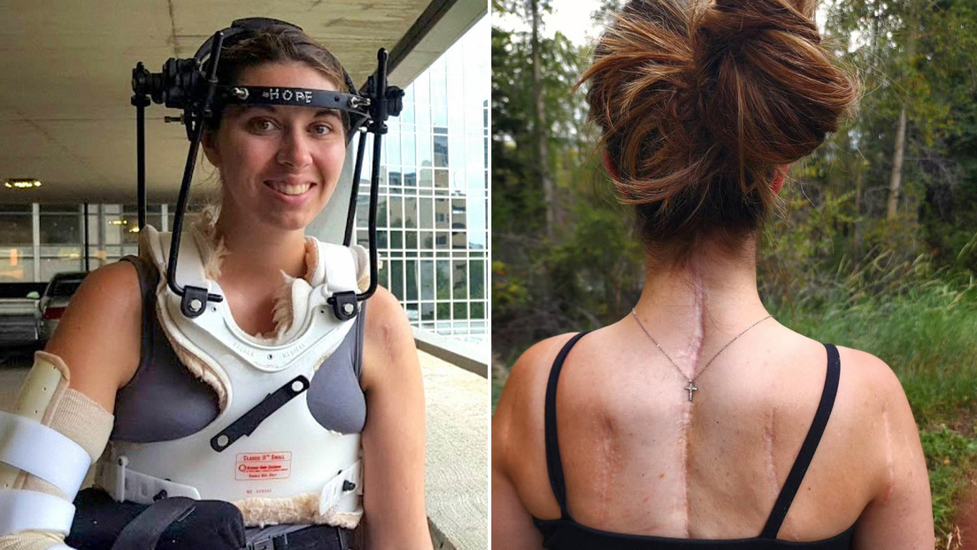 Médicos le unen la cabeza al cuerpo a una mujer que casi queda decapitada haciendo deporte