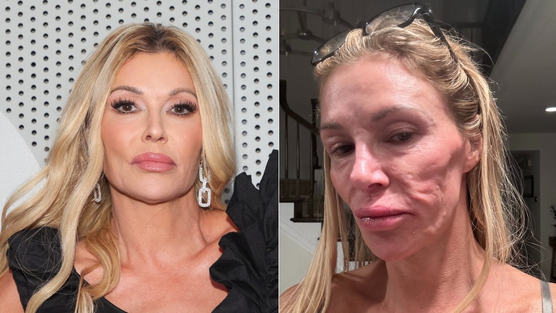 Exestrella de 'Real Housewives' cuenta su lucha contra una rara enfermedad facial