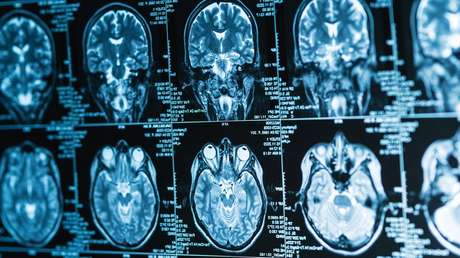 Crean un implante cerebral que convierte pensamientos en palabras en tiempo real