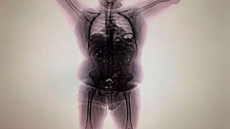 Capturan en Argentina a un viajero con 'una bomba' de cocaína en el estómago