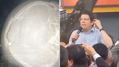 FOTO: Revelan supuesta radiografía del cráneo de Miguel Uribe