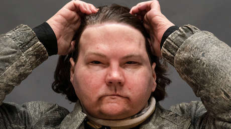 Hombre con trasplante de cara relata qué vio durante su coma de tres meses