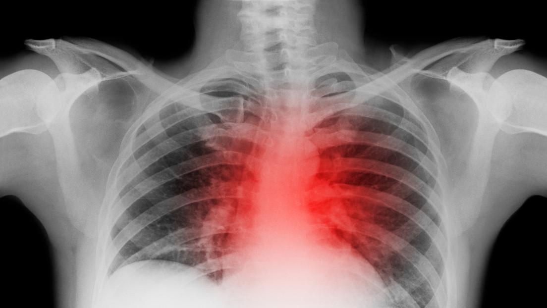 ¿Cuáles son los signos de un paro cardíaco?