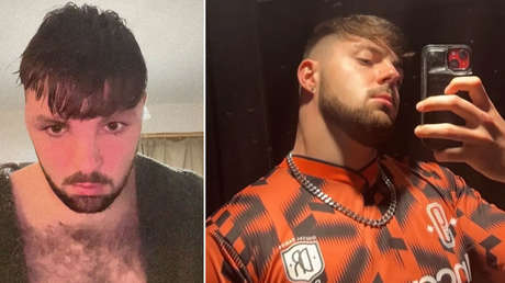 Se somete a un trasplante de pelo, ignora las instrucciones de los médicos y termina así