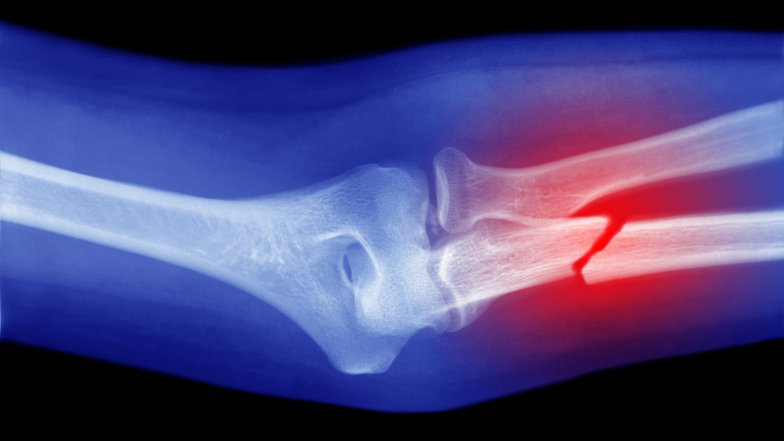 Células capaces de 'convertirse en hueso' podrían ser la clave para curar fracturas graves