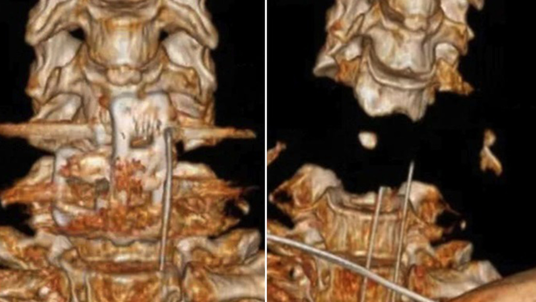 IMPACTANTE FOTO: Brazo robótico se sale de control y casi decapita a un hombre