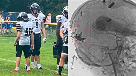 Jugador de fútbol americano sufre una conmoción cerebral y hallan una rara malformación en su cabeza