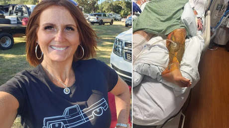 Bacteria 'comecarne' casi deja sin pierna a una mujer (FOTOS FUERTES)