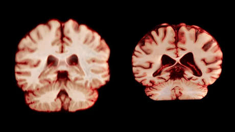 La ciencia confirma: el cerebro de los hombres envejece más rápido