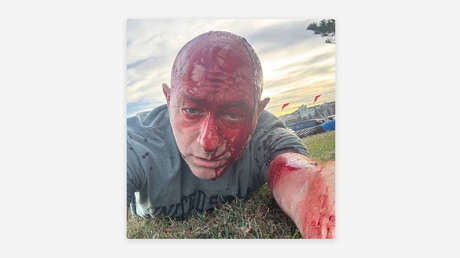 Escalofriante imagen del líder de la comunidad judía tras resultar herido en el tiroteo masivo de Australia (FOTO)