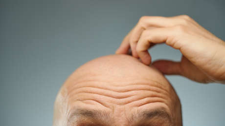 Mujer demanda a su esposo por ocultar su calvicie antes de la boda