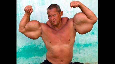 Muere el 'Popeye brasileño', conocido por inyectarse aceite mineral en los brazos