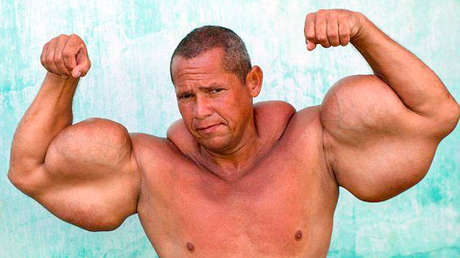 Muere el 'Popeye brasileño', conocido por inyectarse aceite mineral en los brazos