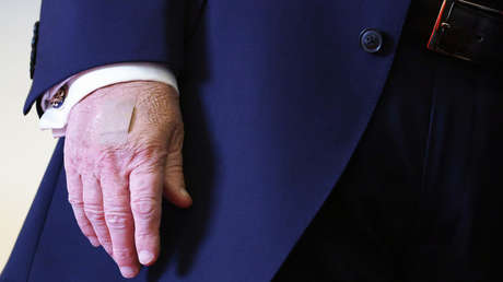 Trump habla sobre cómo apareció el moretón en su mano izquierda