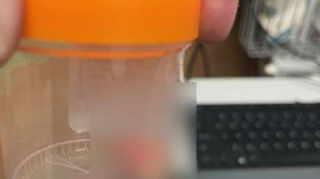 IMAGEN FUERTE: Manifestante arranca el dedo de un mordisco a un agente del ICE