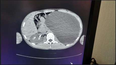 Creía estar sano, pero un chequeo rutinario destapó la "bomba de relojería" que llevaba dentro