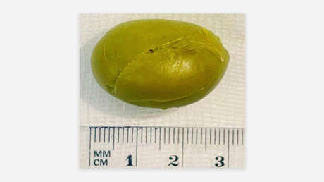 Médicos rusos salvan a un niño que tenía una aceituna atascada en el estómago