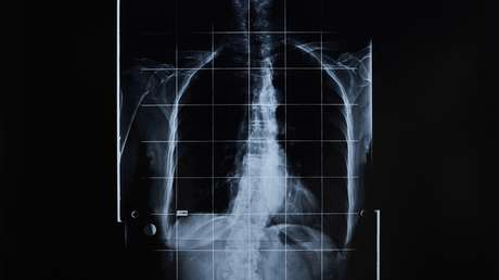 "Sacos de órganos": una startup apoyada por un multimillonario quiere crear cuerpos humanos sin cerebro