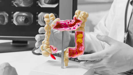 Muertes por cáncer colorrectal crecen entre este grupo de jóvenes